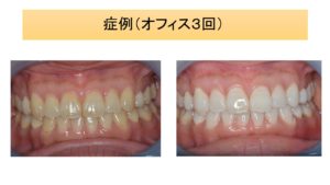 オフィスホワイトニングを３回行った写真""