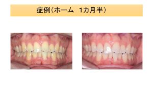 ホームホワイトニングを１ヶ月半行った写真