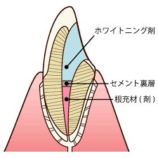 ウォーキングブリーチ法