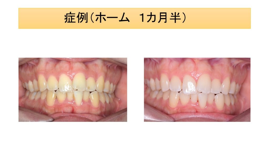 ホームホワイトニング