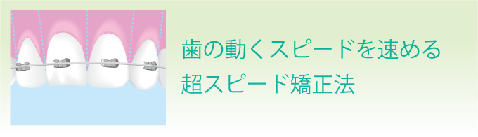 スピード矯正 JET SYSTEM