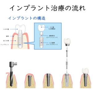 インプラント治療の流れ