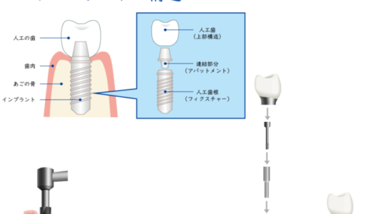 歯科口腔外科治療 インプラント治療の流れ