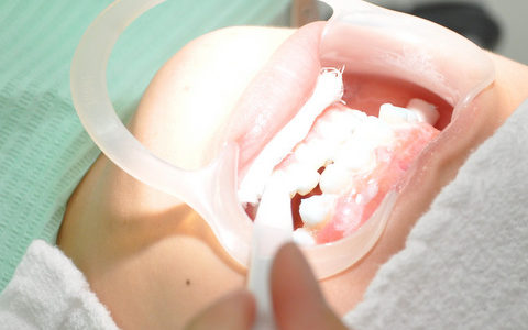 歯科ホワイトニングの注意点