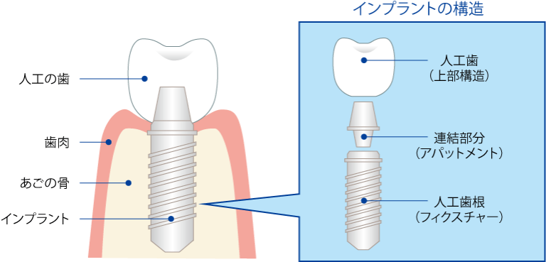 インプラントの構造