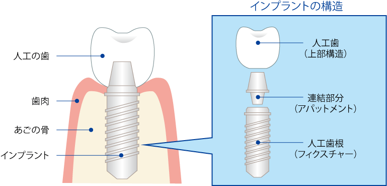 インプラントの構造 インプラントの構造