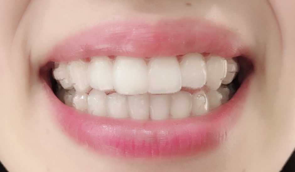 インビザライン　～名駅アール歯科・矯正歯科～