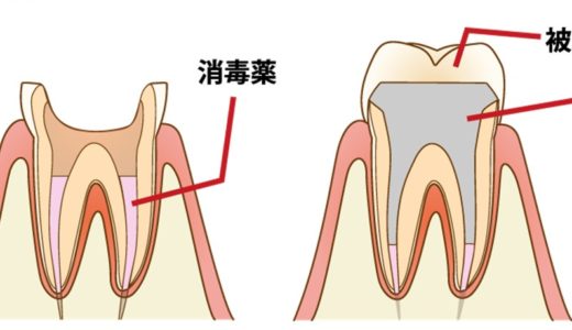 虫歯の処置について　神経の処置②
