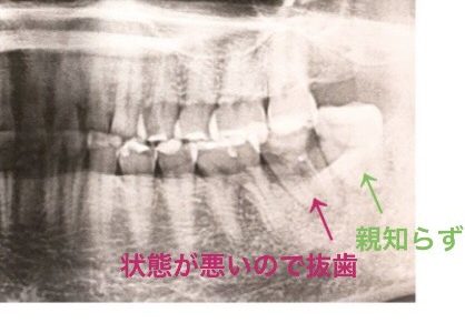 抜歯後の骨のできかた