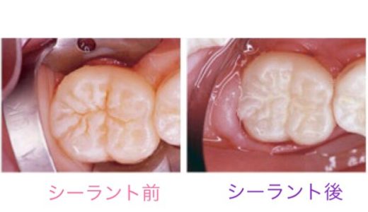 虫歯予防処置シーラント