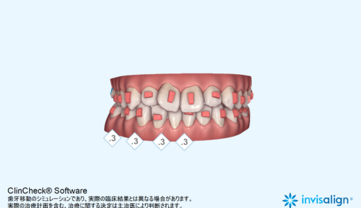 インビザラインのアタッチメント