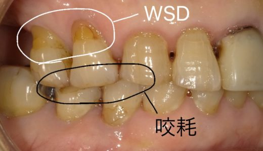 悪習癖　(ブラキシズム）