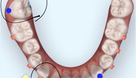 矯正記録　インビザライン