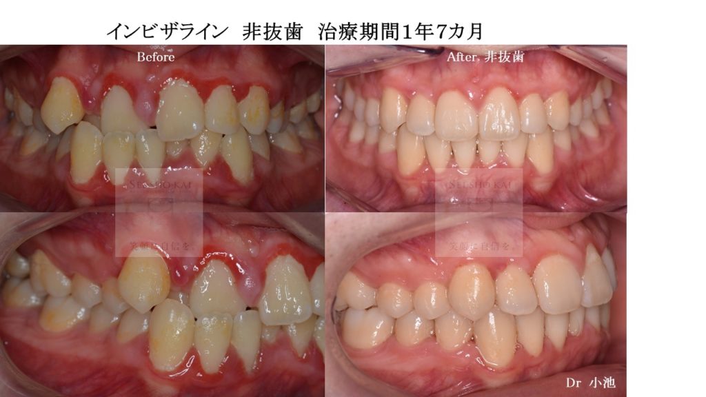 インビザライン矯正 非抜歯 名古屋駅で歯列矯正なら名駅アール歯科 矯正歯科