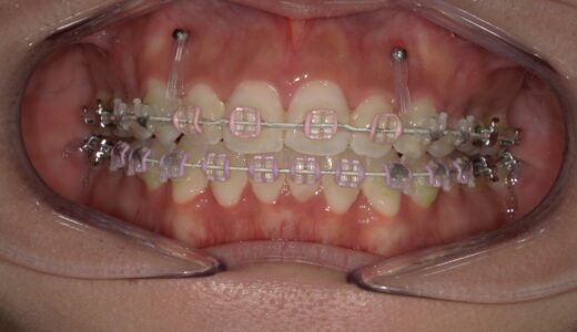 矯正とガミースマイル