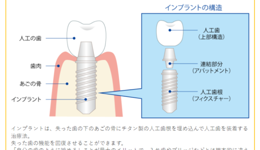 インプラントの流れ　