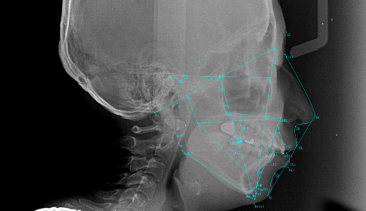 セファロ分析について