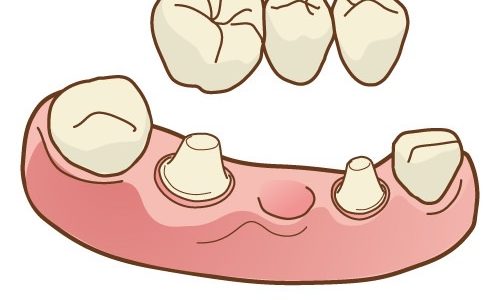 ブリッジの正しい清掃方法とは？放置リスクとセルフケアを解説