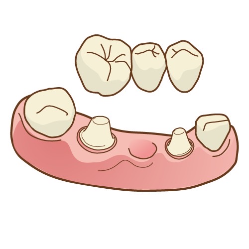 ブリッジの正しい清掃方法