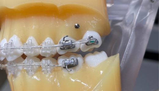 矯正治療のバイトアップとは？必要な理由と食事・虫歯の注意点