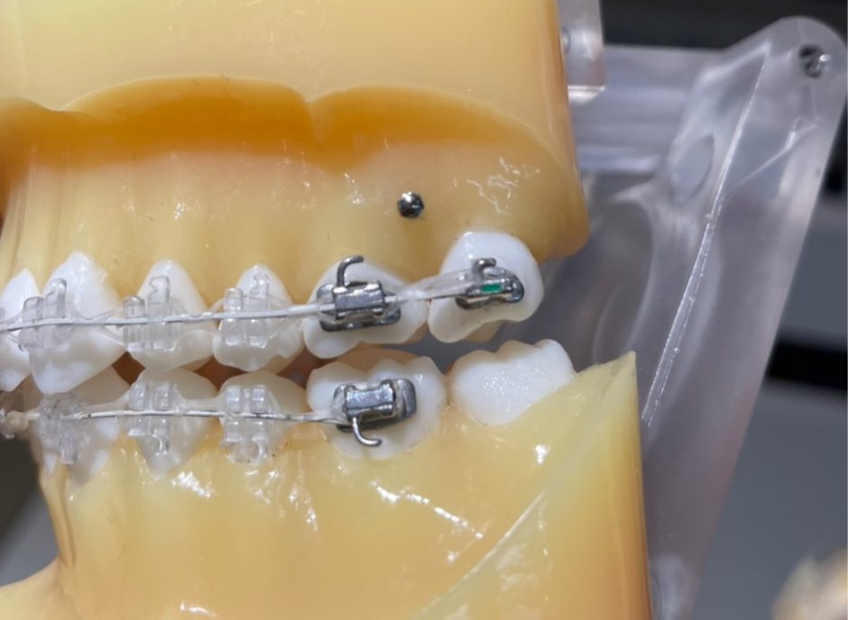 バイトアップとは