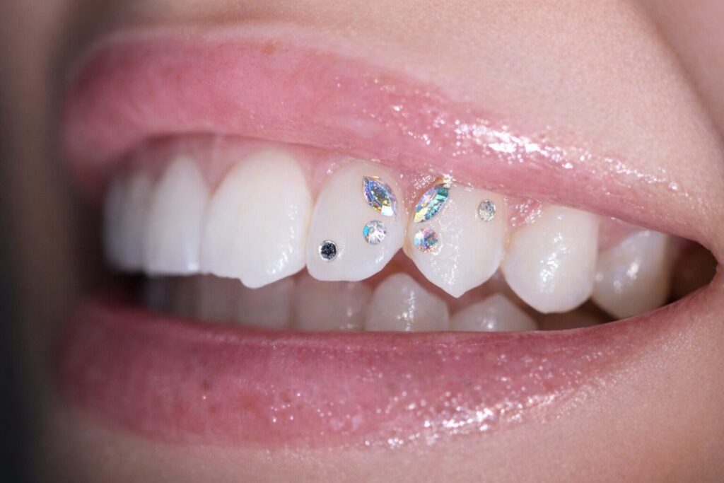 ティースジュエリー（歯ジュエリー）