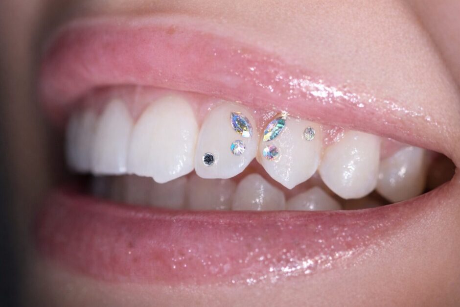 ティースジュエリー（歯ジュエリー）