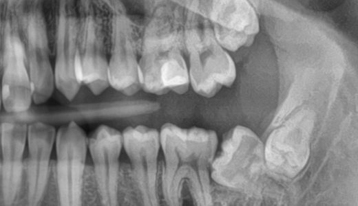 　”抜歯と言われた歯を残す矯正”　症例紹介