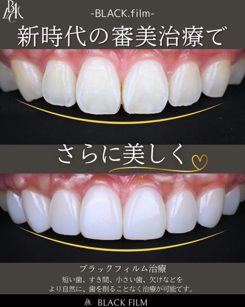 ブラックフィルム