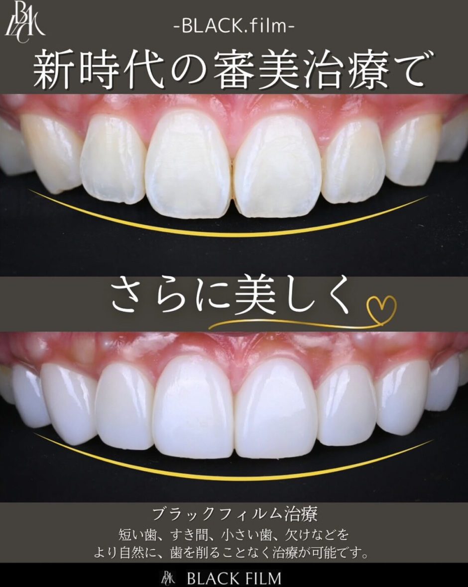 ブラックフィルム