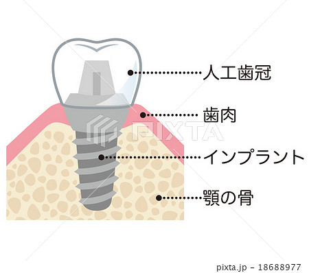 歯 インプラント 構造 名称のイラスト素材 [18688977] - PIXTA