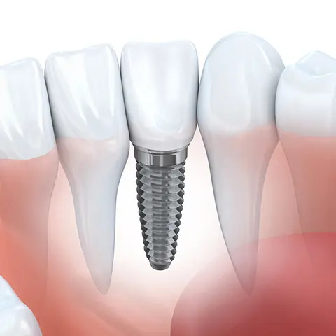 インプラント治療とは インプラント治療とは