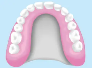 金属床義歯 金属床義歯