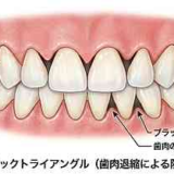 ブラックトライアングルができる原因