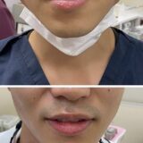 ボツリヌストキシン治療