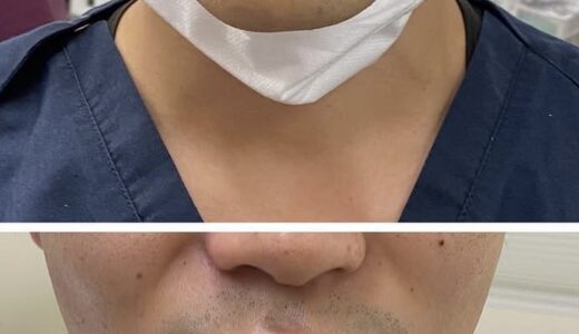 ボツリヌストキシン治療