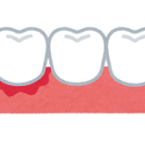 🦷歯ぐきから血が出る…これって大丈夫？
