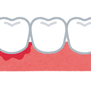 🦷歯ぐきから血が出る…これって大丈夫？