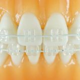 歯科矯正のメリットデメリット