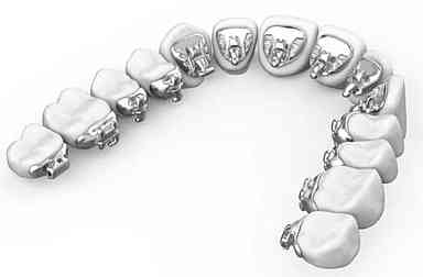 裏側矯正のメリット