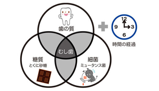 虫歯のメカニズム