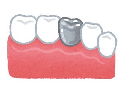 銀歯の寿命